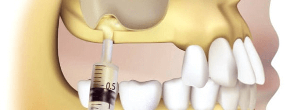 Синус-лифтинг после удаления зуба